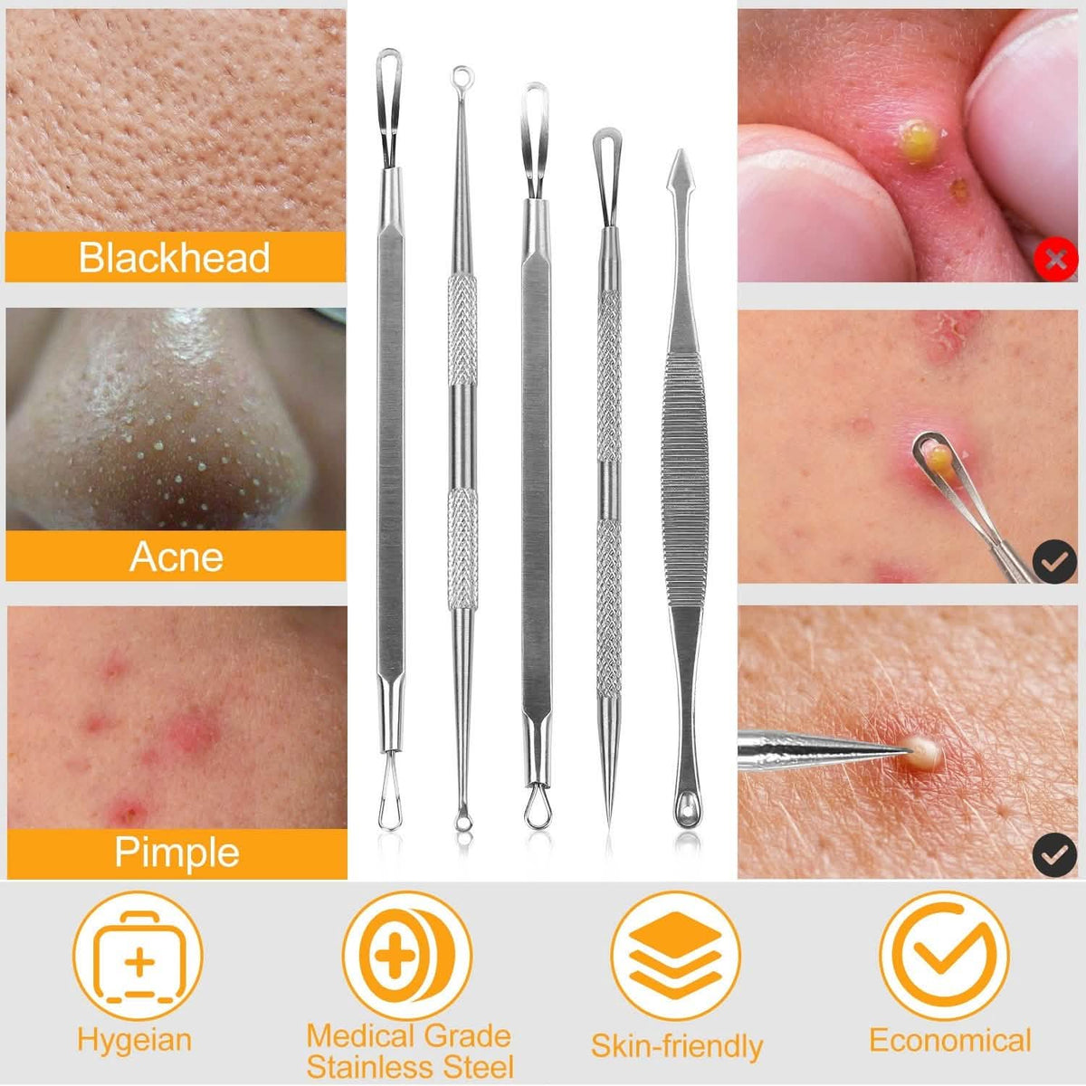 5-Piece Set: Blackhead Remover Kit Stainless Steel Popping Zit Remover - A-1 Thread Vault