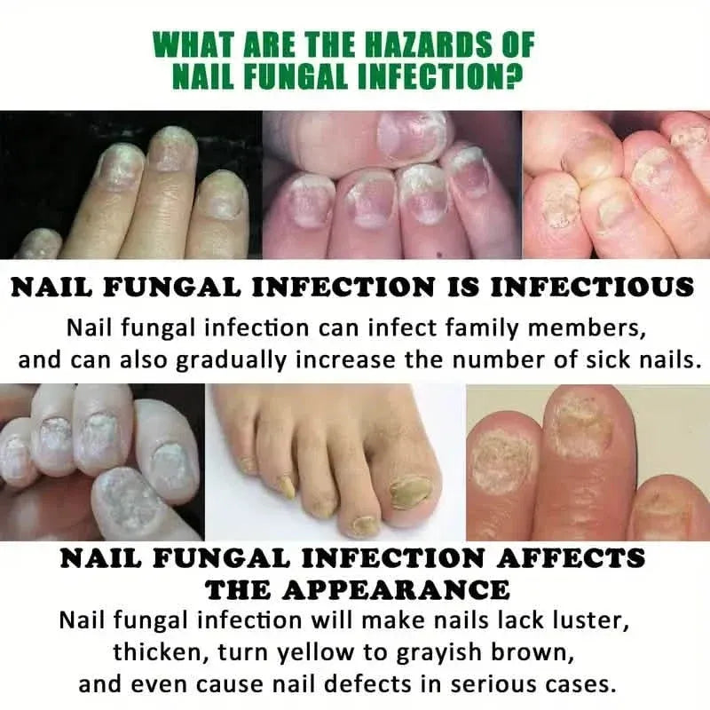 Ginger Nail Care Liquid Onychomycosis Fungus Repair Hand and Foot Nail Care - A-1 Thread Vault