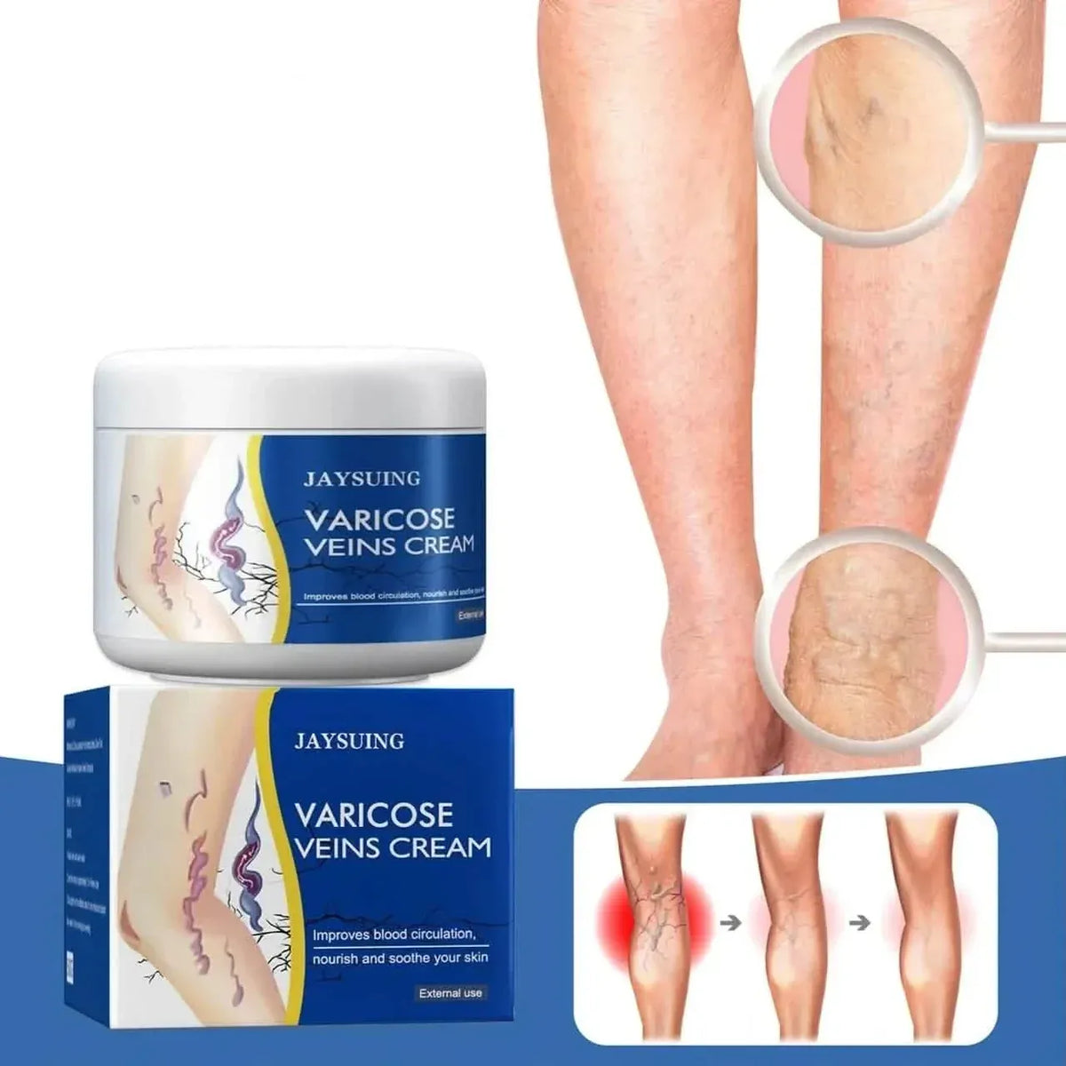 Pain Relief Leg Spider Veins Vasculitis Promote Circulation Smooth Metabolism 30g Exfoliation - A-1 Thread Vault