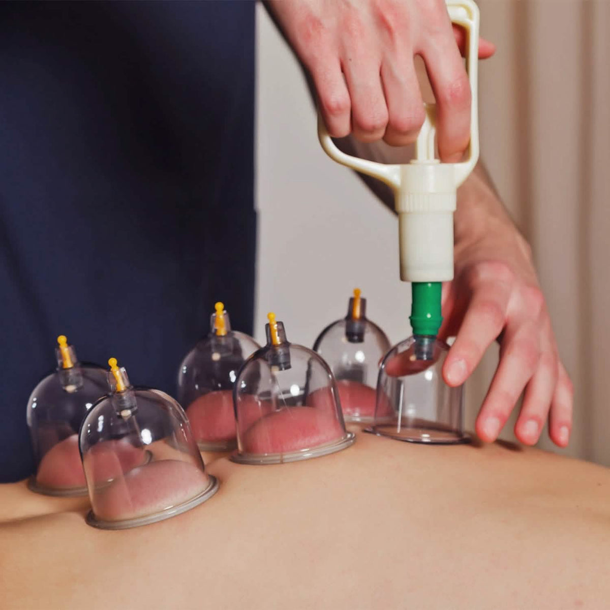 32 Cups Chinese Therapy Set - A-1 Thread Vault