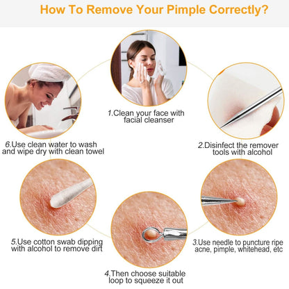 5-Piece Set: Blackhead Remover Kit Stainless Steel Popping Zit Remover - A-1 Thread Vault