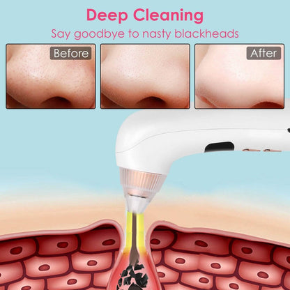 Blackhead Vacuum Remover Electric Blackhead Comedone Extractor - A-1 Thread Vault