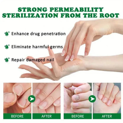 Ginger Nail Care Liquid Onychomycosis Fungus Repair Hand and Foot Nail Care - A-1 Thread Vault