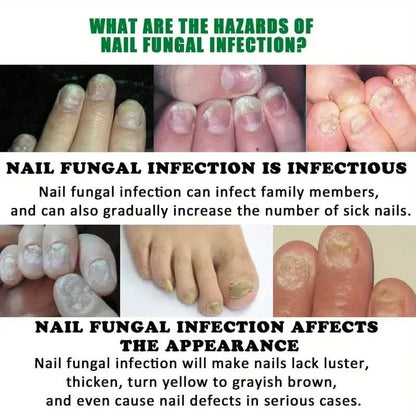 Ginger Nail Care Liquid Onychomycosis Fungus Repair Hand and Foot Nail Care - A-1 Thread Vault