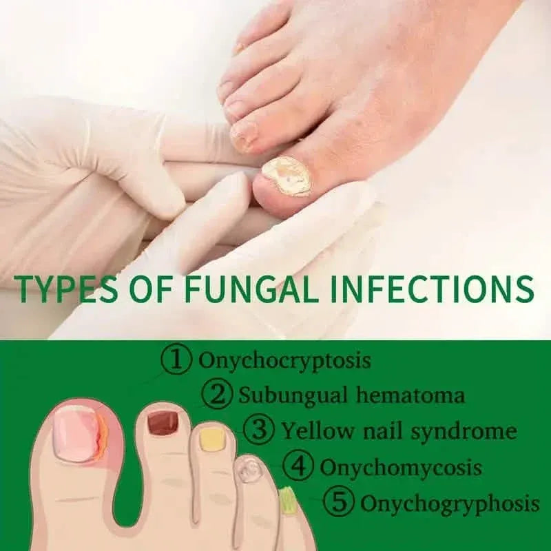 Ginger Nail Care Liquid Onychomycosis Fungus Repair Hand and Foot Nail Care - A-1 Thread Vault