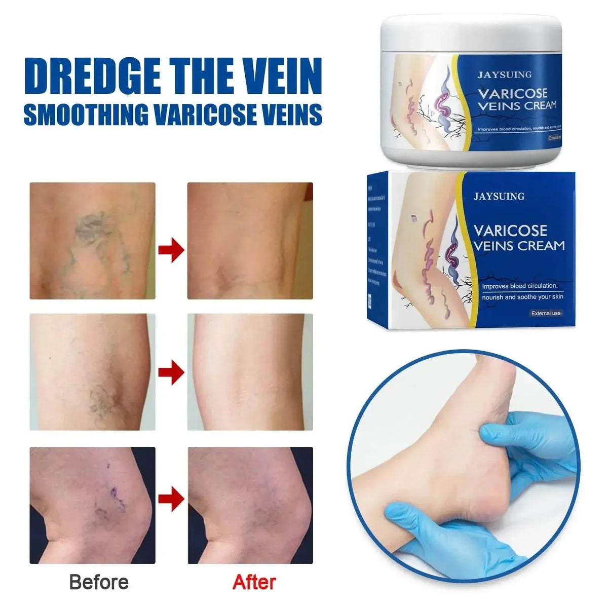 Pain Relief Leg Spider Veins Vasculitis Promote Circulation Smooth Metabolism 30g Exfoliation - A-1 Thread Vault