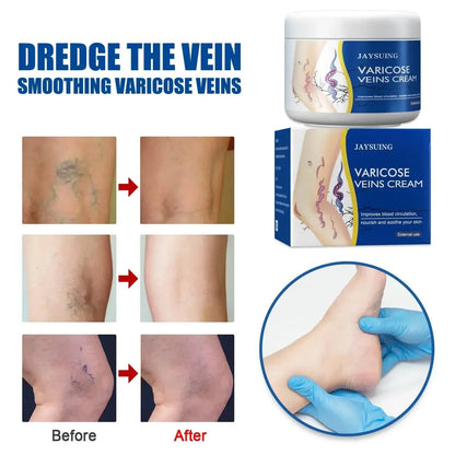 Pain Relief Leg Spider Veins Vasculitis Promote Circulation Smooth Metabolism 30g Exfoliation - A-1 Thread Vault